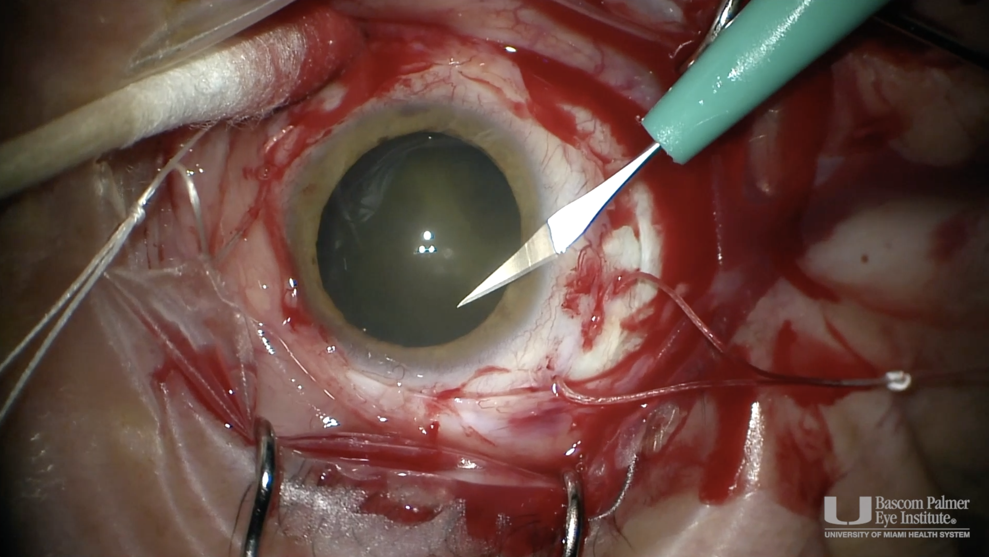 External Drainage of Choroidal Melanoma Retinal Detachment
