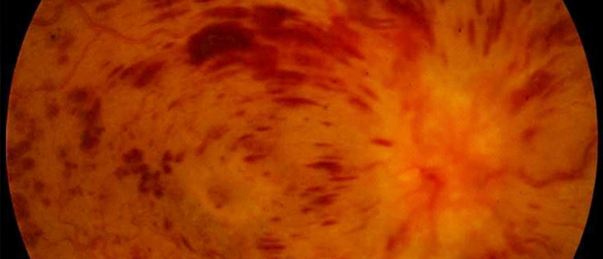 Central Retinal Vein Occlusion in Patient with MTHFR Mutation