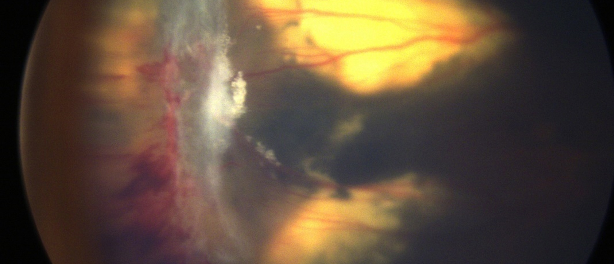 Familial Exudative Vitreoretinopathy