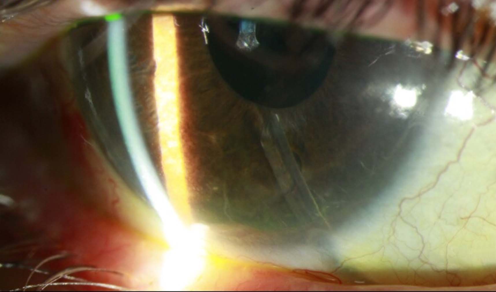 Glaucoma Drainage Device Exposure