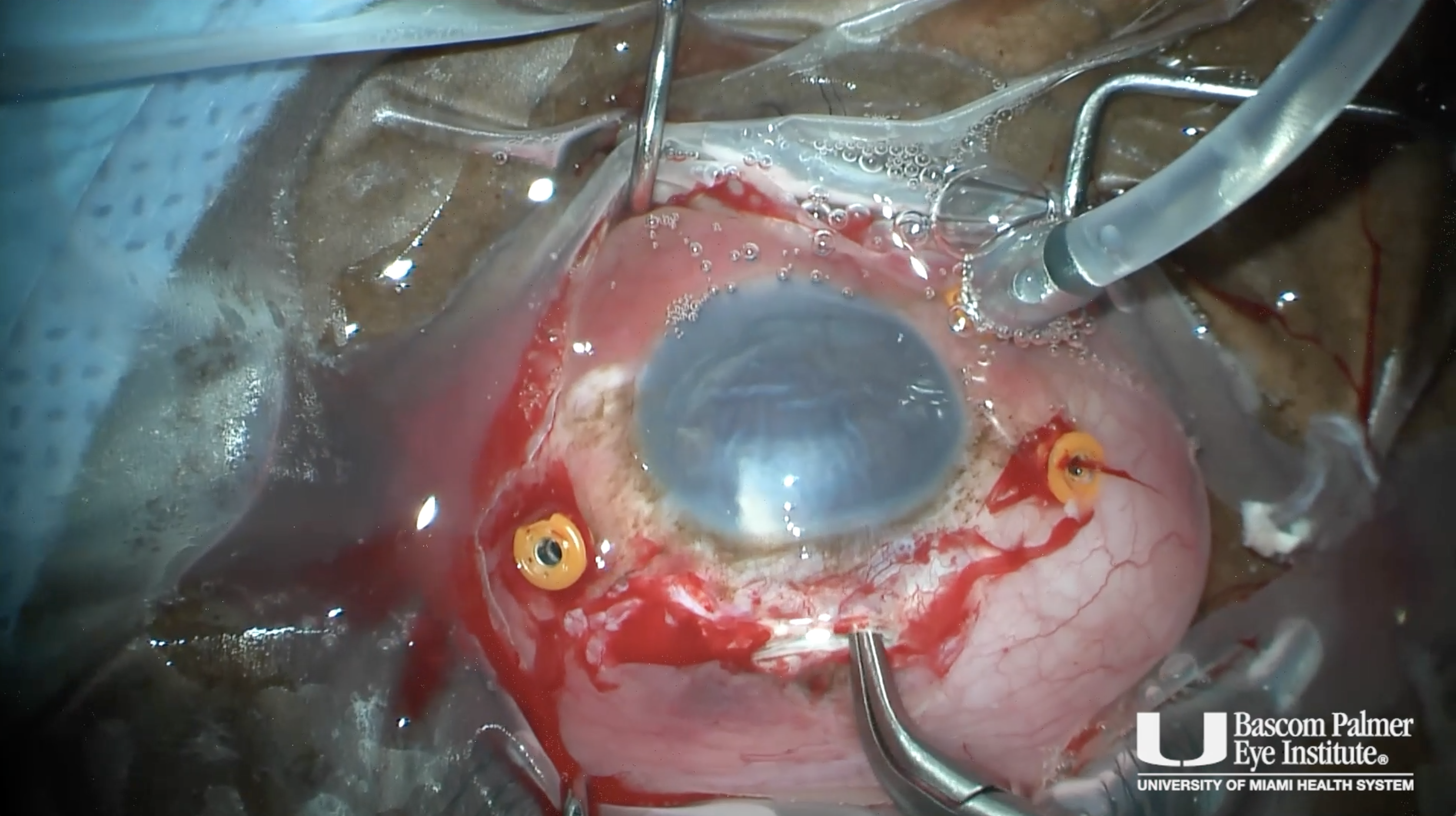Removal of Soemmering Ring and Scleral Fixation of Dislocated IOL
