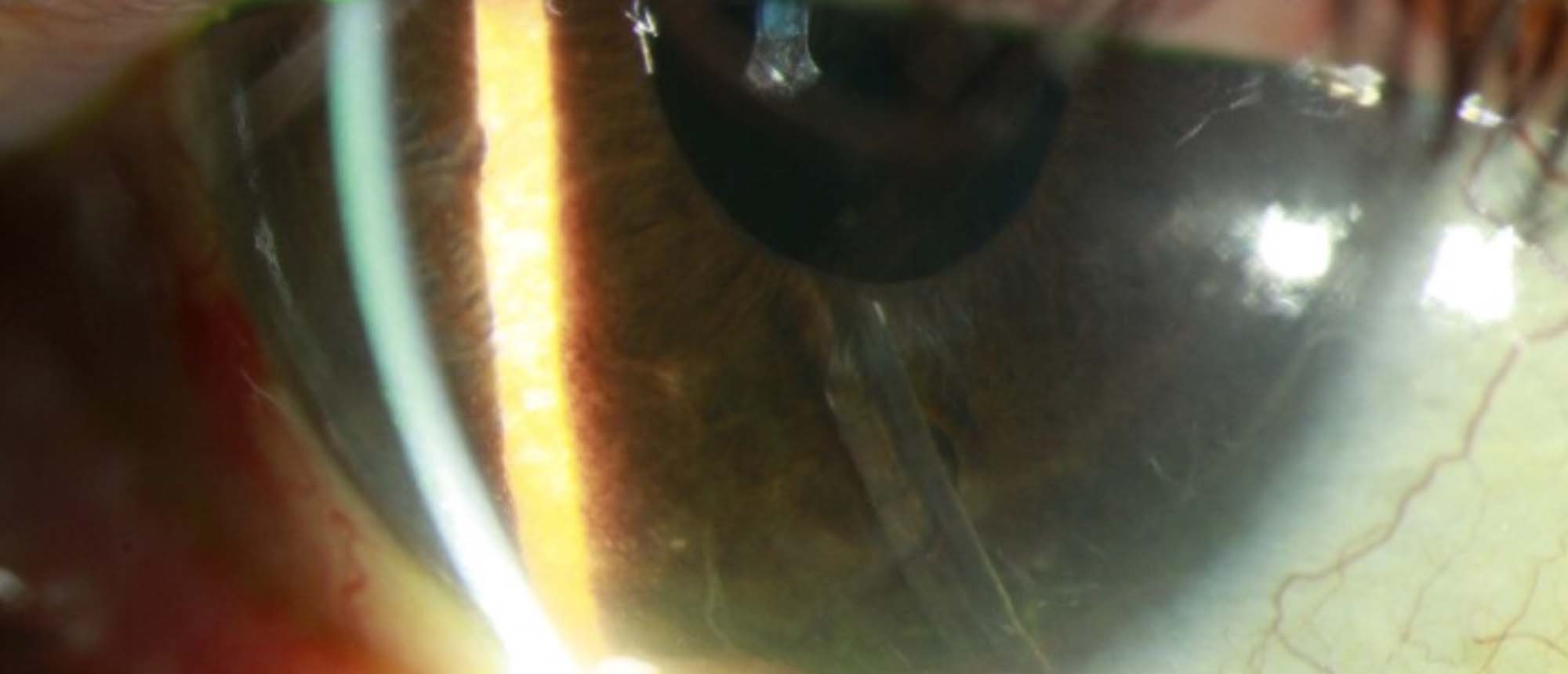 Exposed Glaucoma Drainage Device