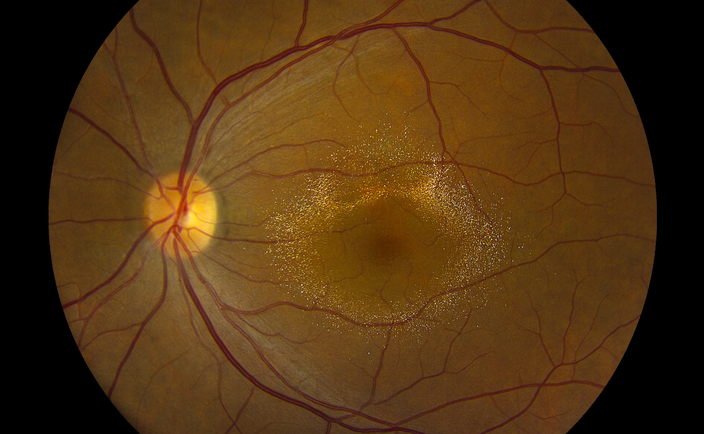 Canthaxanthin Crystalline Retinopathy