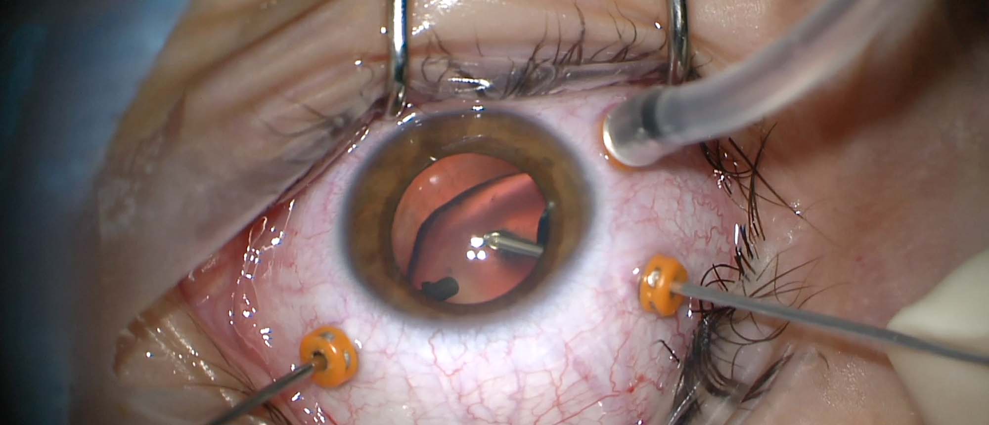 Pars Plana Lensectomy and Vitrectomy for Subluxed Lens in Marfan Syndrome