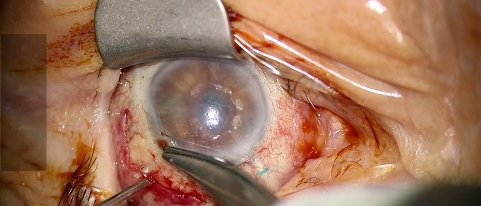 Glaucoma Drainage Device Revision