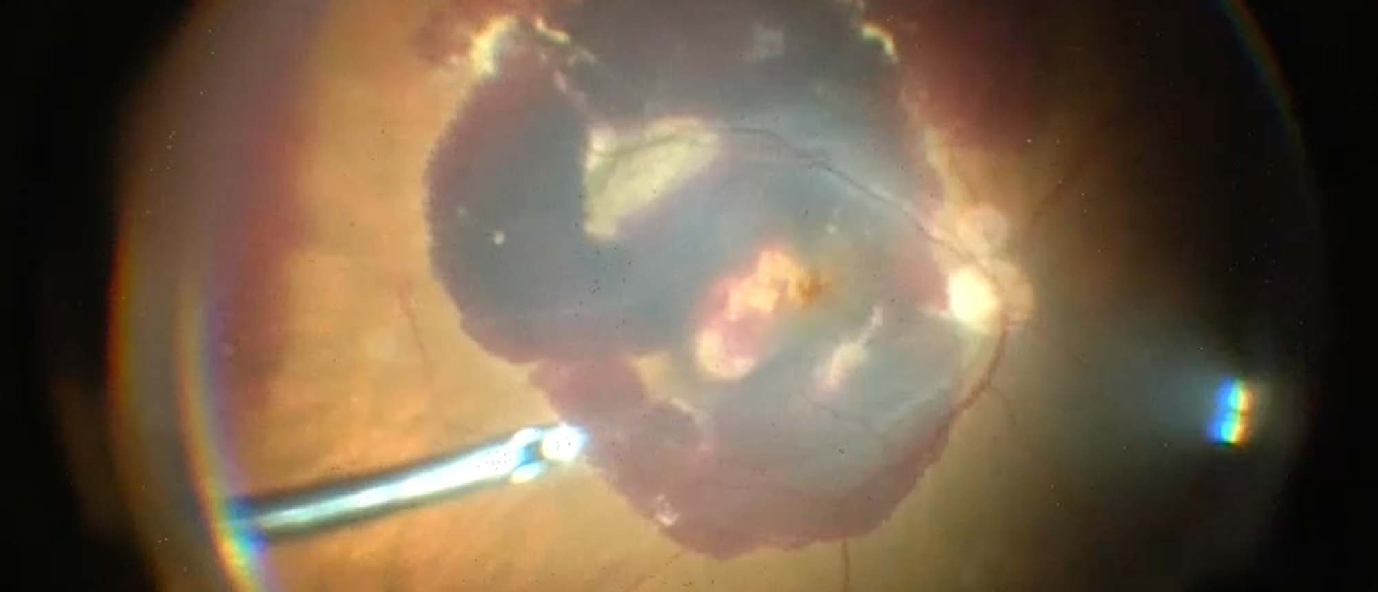 Vitrectomy and Sub Retinal TPA for Macula Hemorrhage
