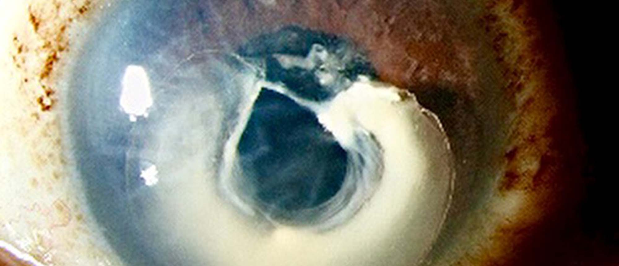 Removal of Soemmering Ring and Scleral Fixation of Disclocated IOL