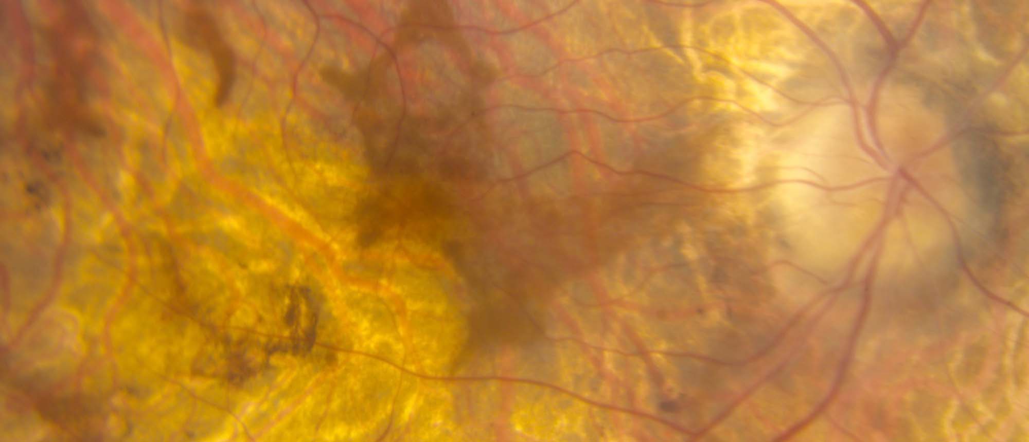 C2orf71 Retinitis Pigmentosa