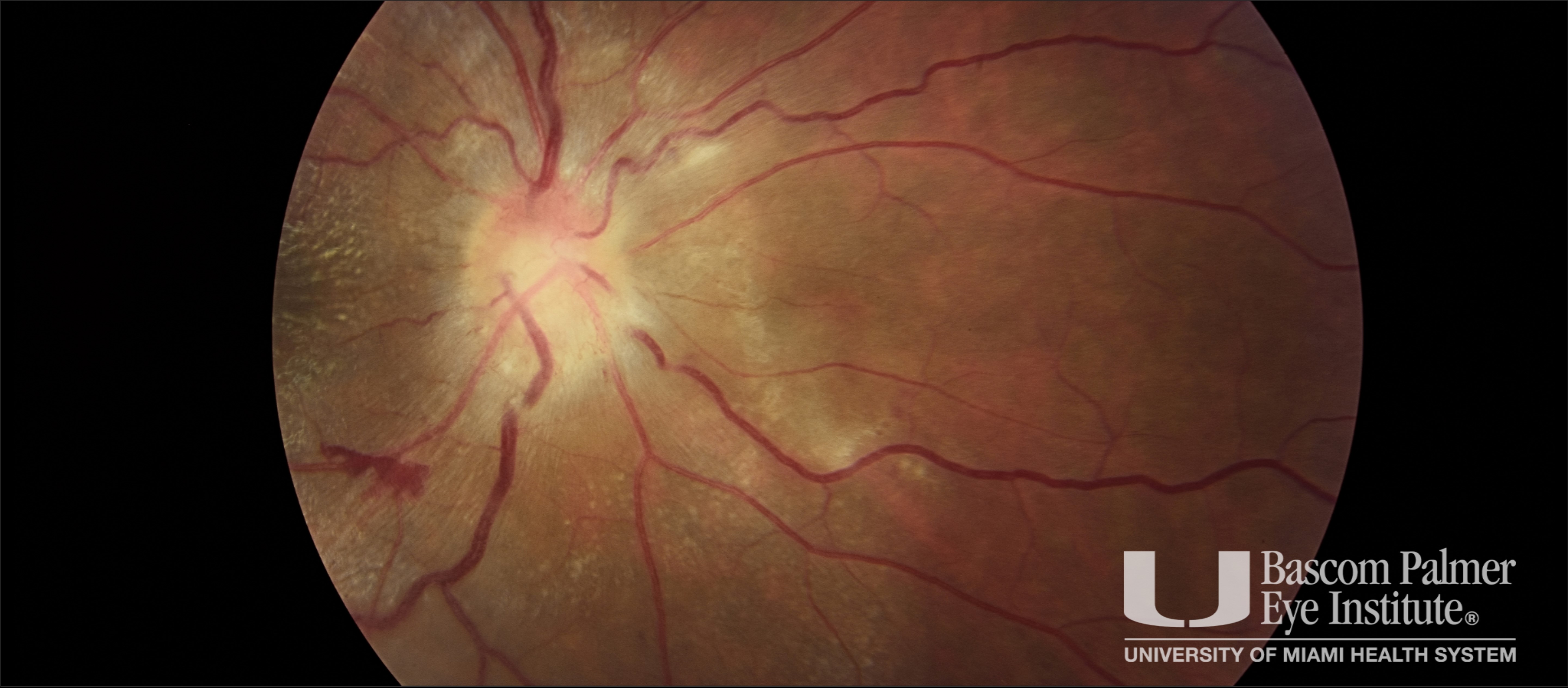 Ocular Bartonella Henselae Infection