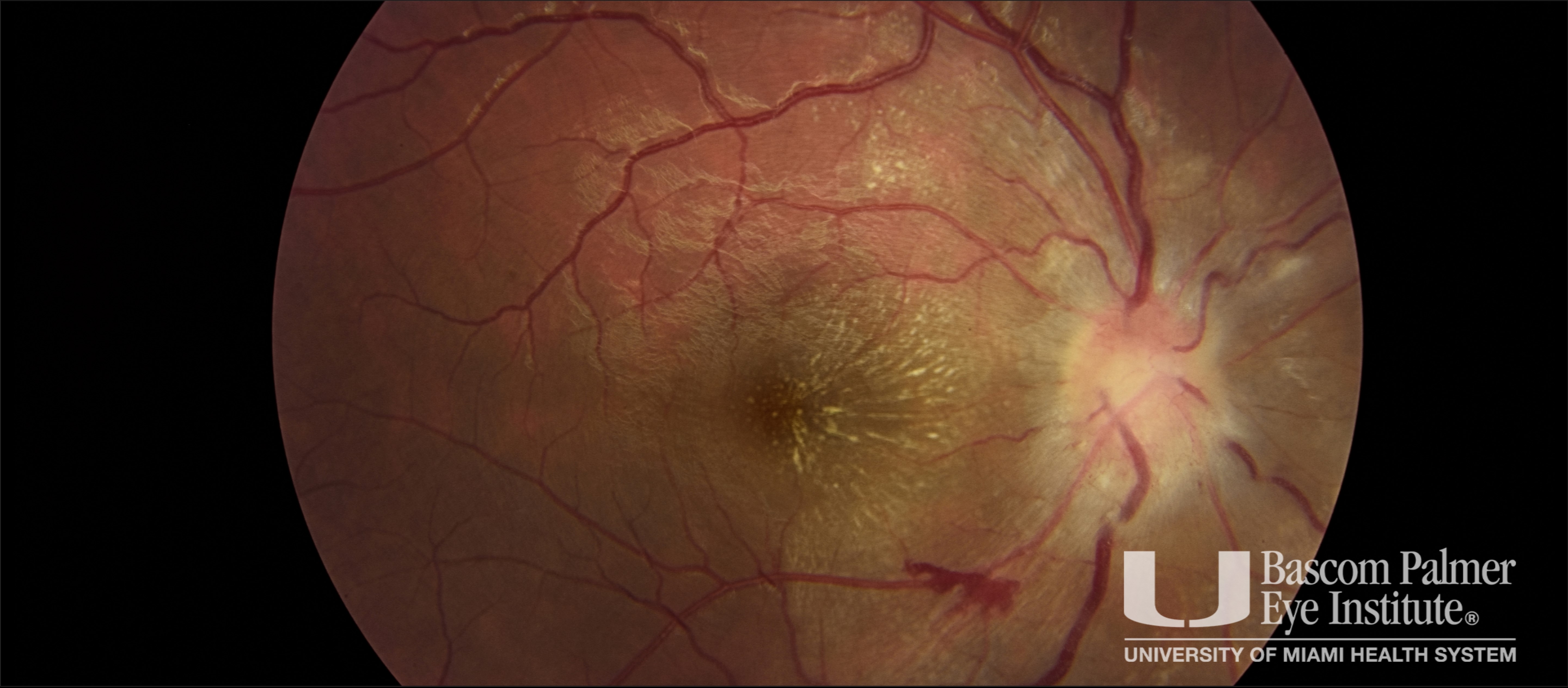 Ocular Bartonella Henselae Infection