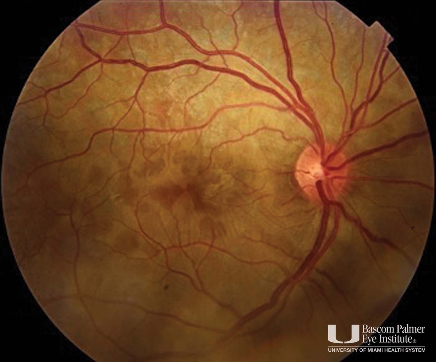 Acute Posterior Placoid Pigment Epitheliopathy