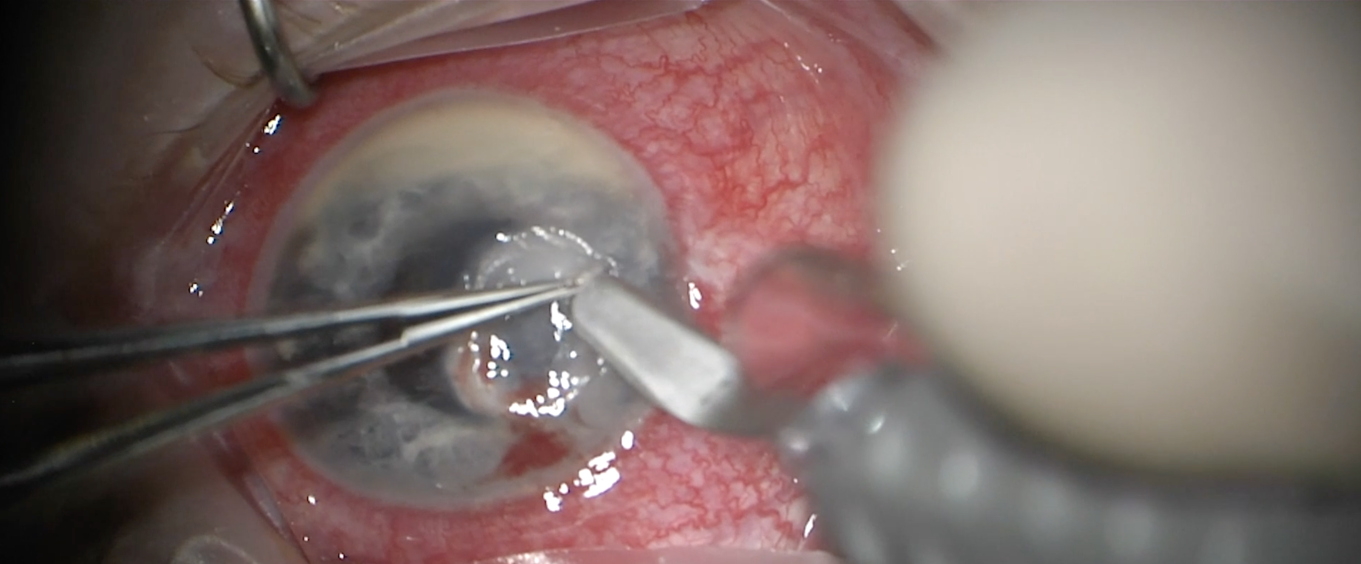 Conjunctival Flap for Aspergillus Keratitis