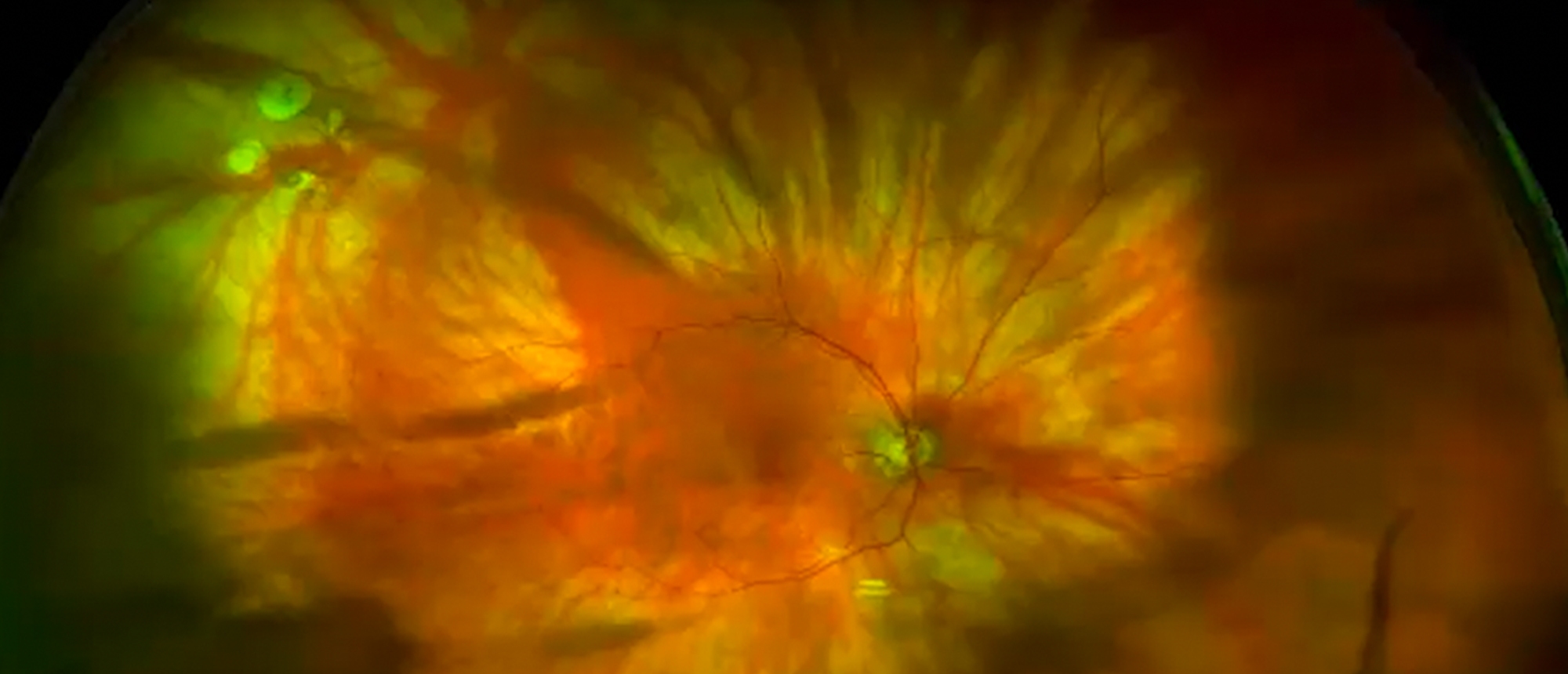 Hydrolyzed MIRAgel Scleral Buckle