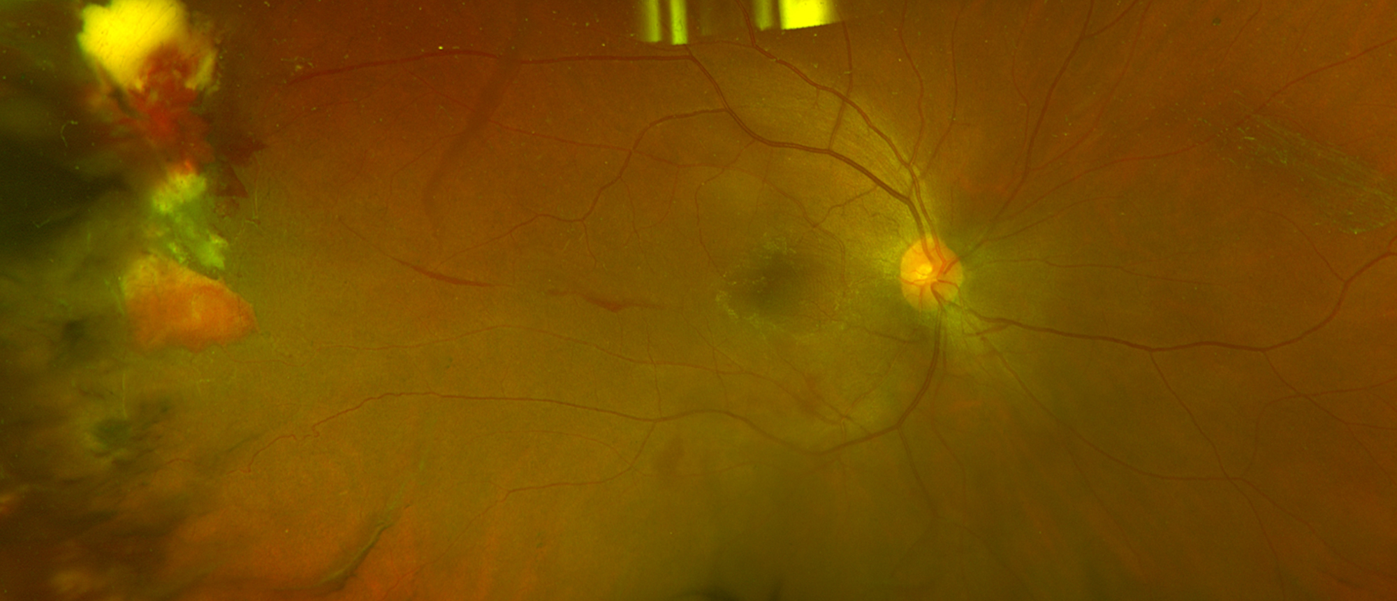Autosomal Dominant Neovascular Inflammatory Vitreoretinopathy