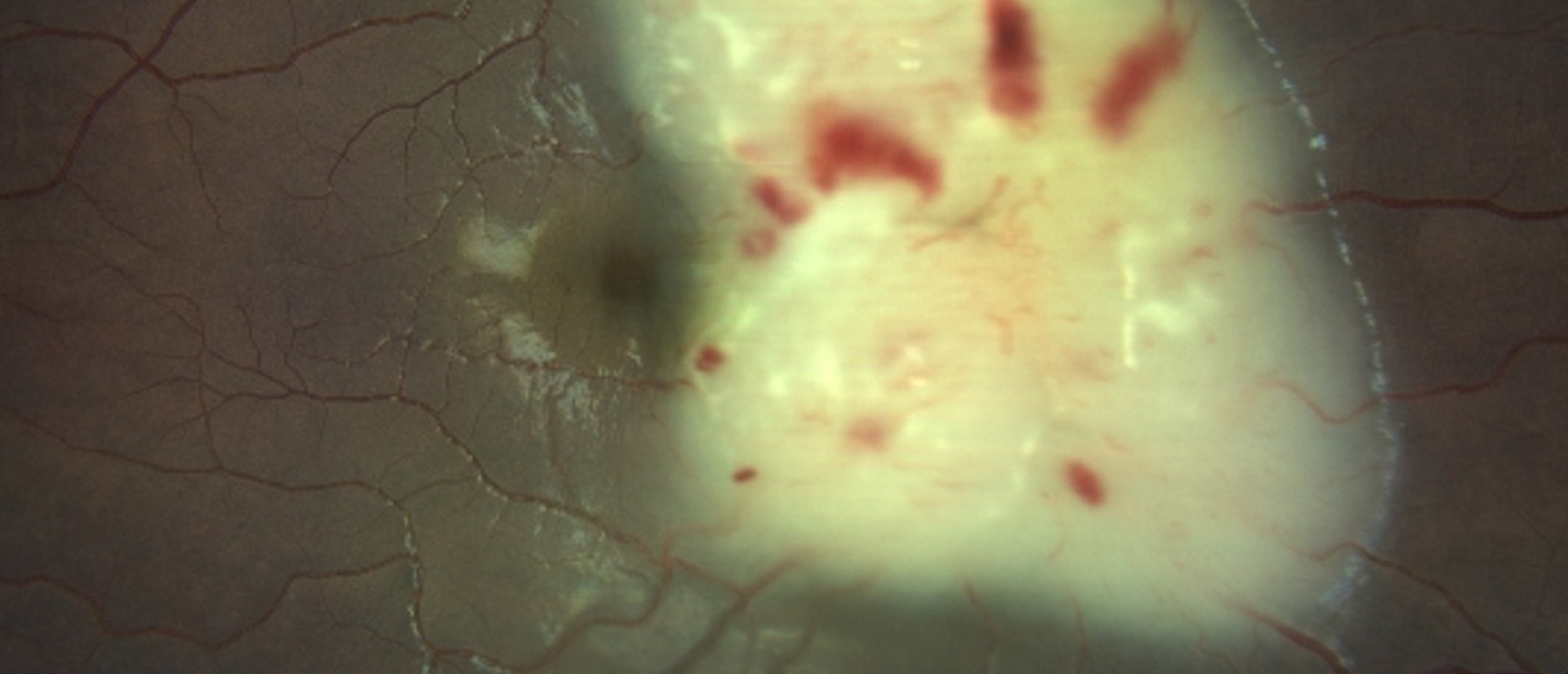 Leukemic Optic Neuropathy