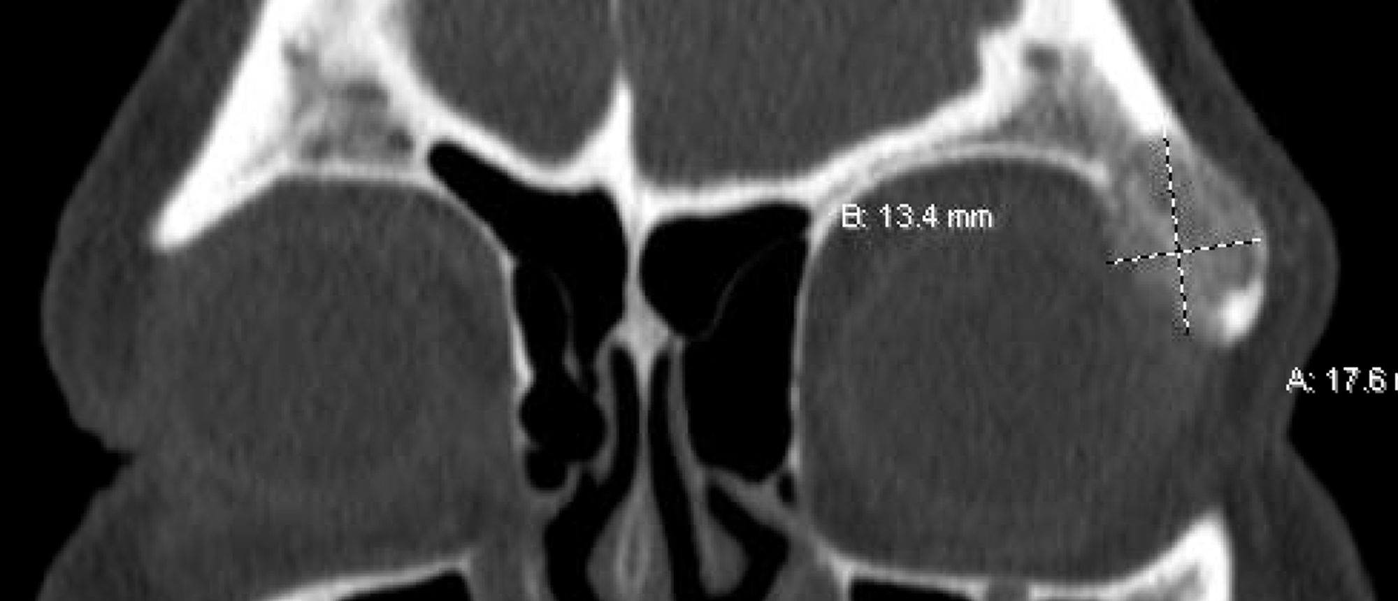 Intraosseous Hemangioma