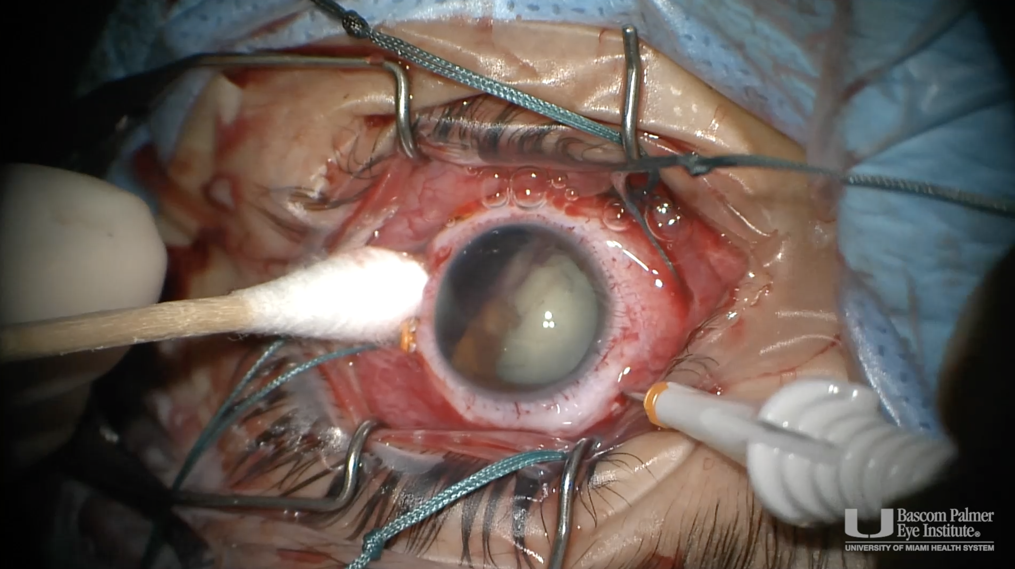 Vitrectomy, Membrane Peel and Lensectomy for Traumatic Macular Hole and Subretinal Hemorrhage due to Air Gun Injury