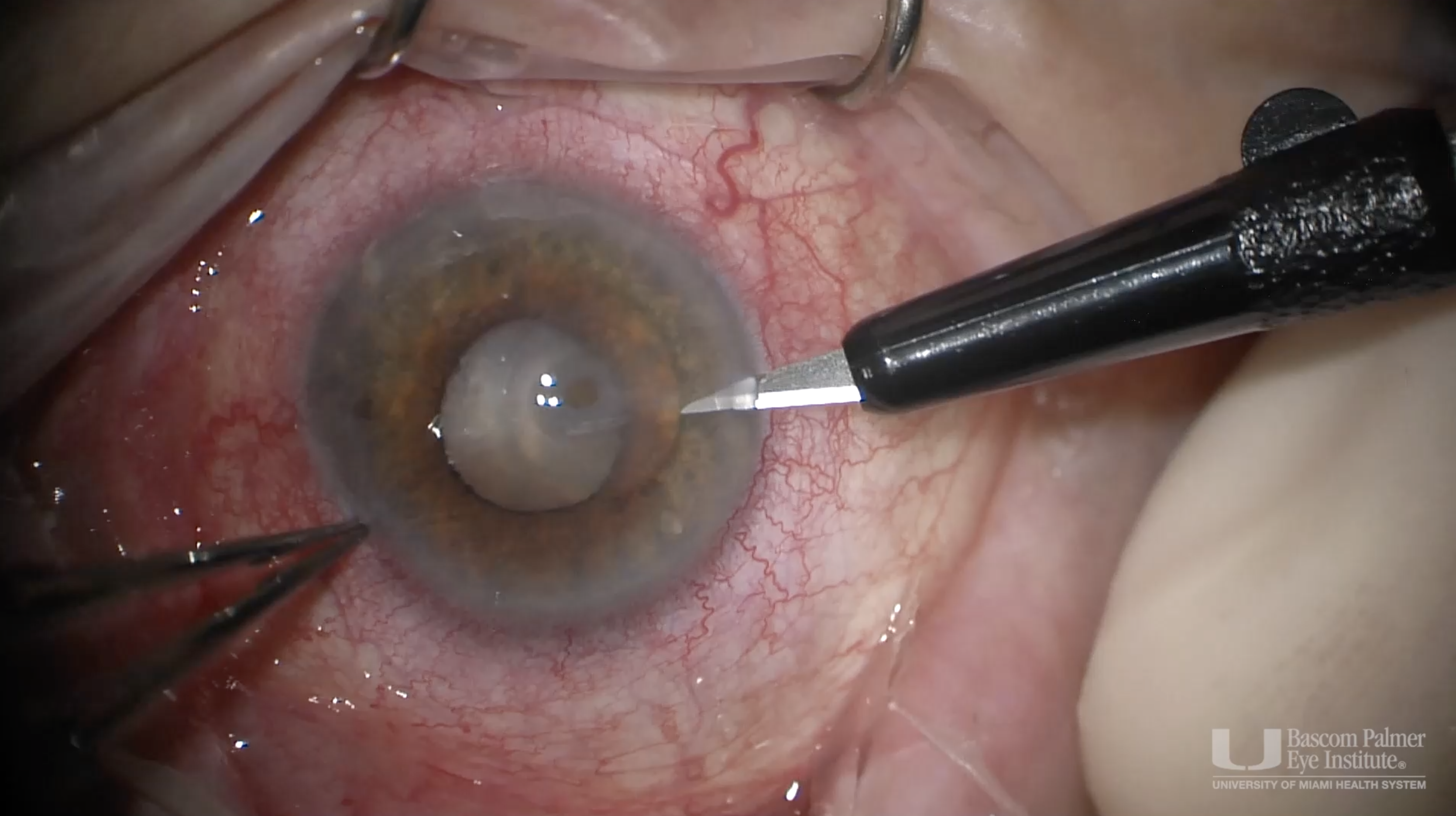 Lamellar Keratectomy, Corneal Patch Graft, Sutured Amniotic Membrane for Neurotrophic Corneal Ulcer with Descemetocele