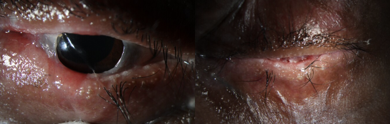 Cicatricial Conjunctivitis, Steven Johnson Syndrome
