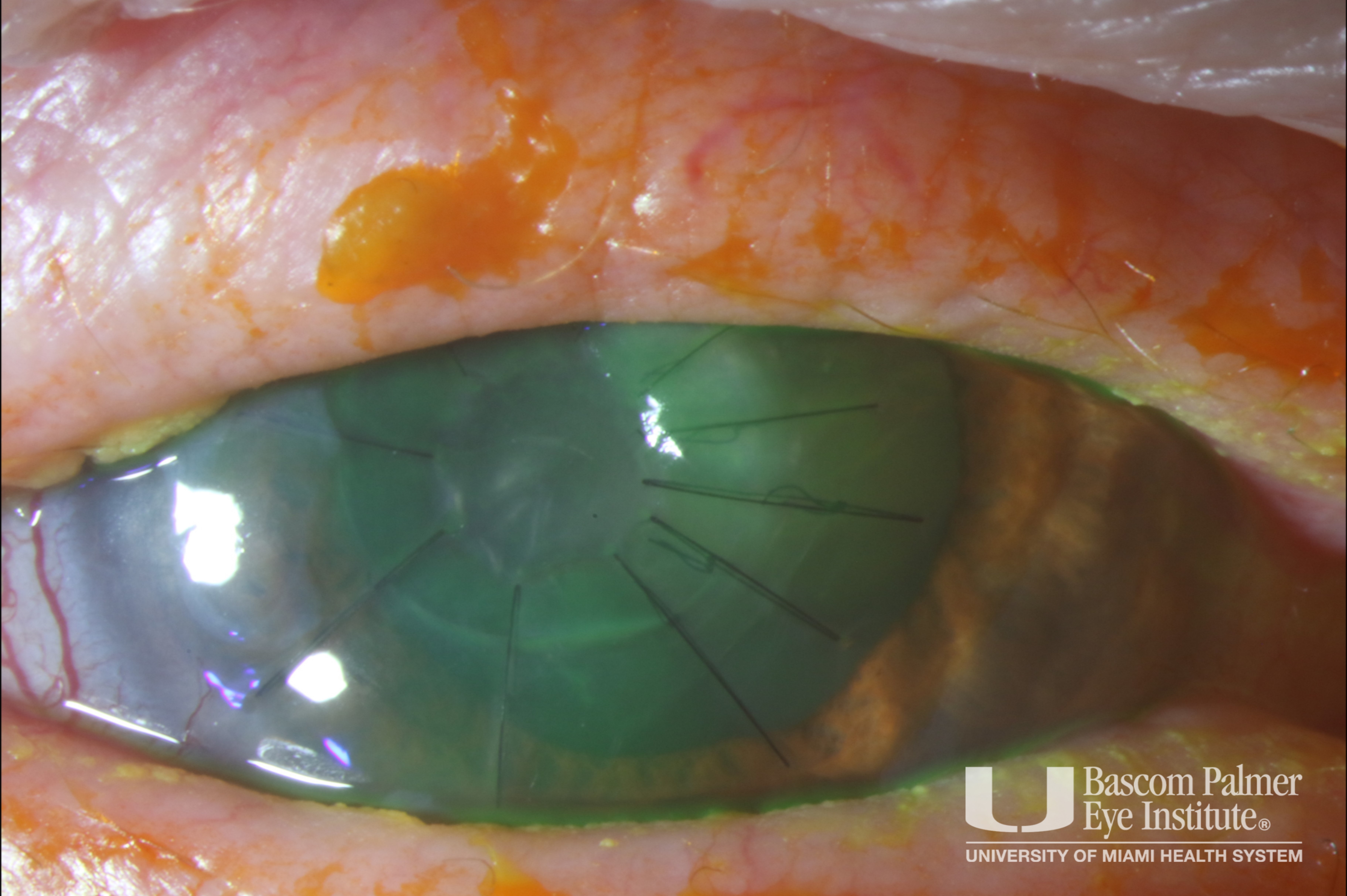 Neurotrophic Corneal Ulcer