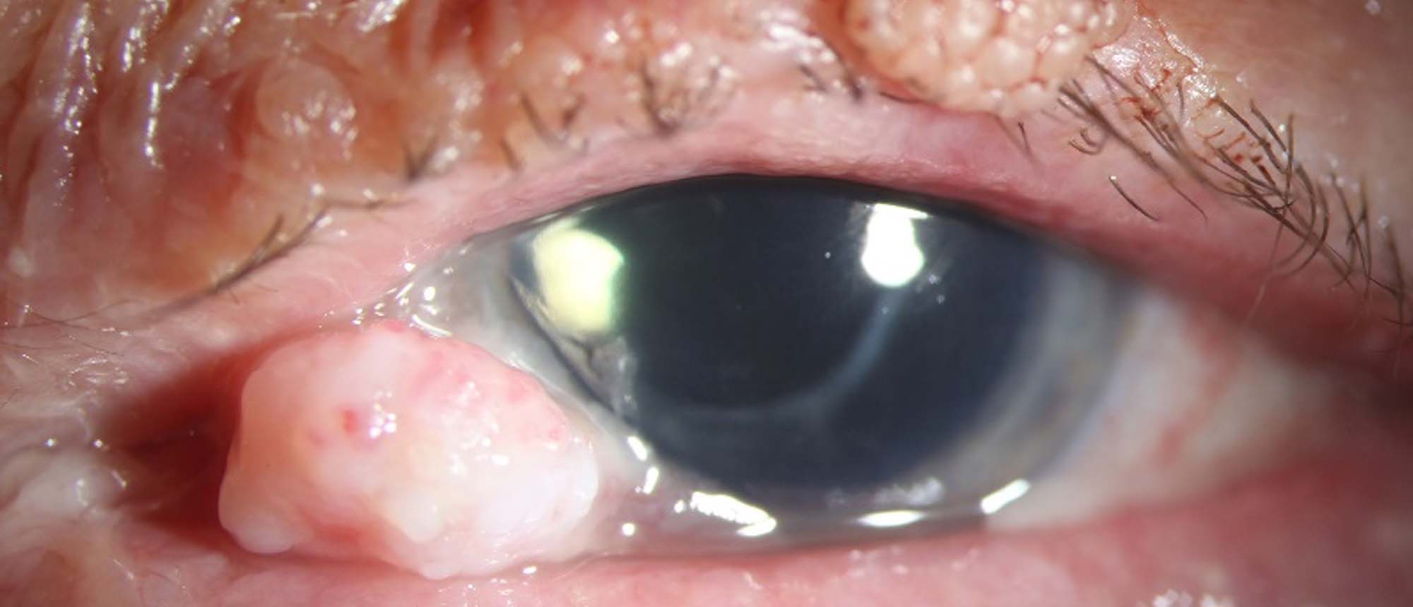Conjunctival Squamous Cell Carcinoma, Keratoacanthoma Type