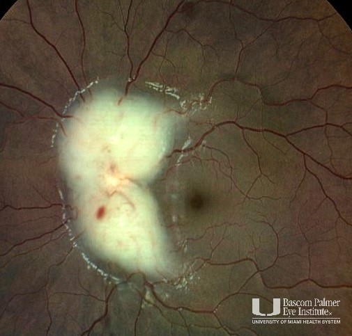 A pediatric patient with leukemic infiltrate of the optic nerve in both eyes