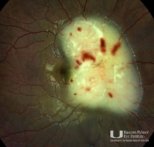 A pediatric patient with leukemic infiltrate of the optic nerve in both eyes. 
