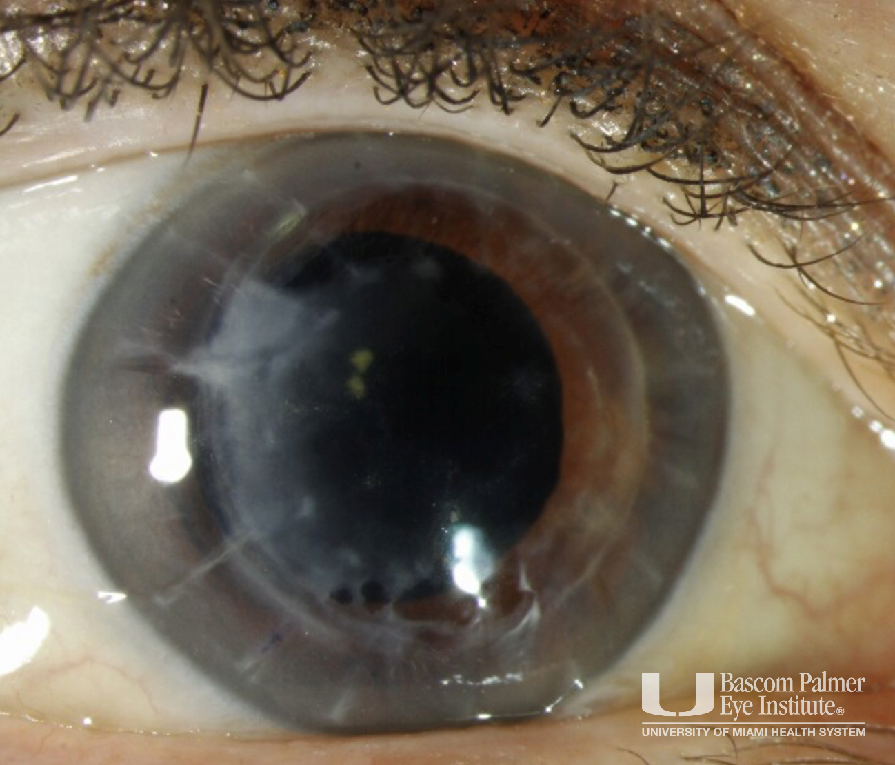 Acquired Corneal Subepithelial Hypertrophy (ACSH)