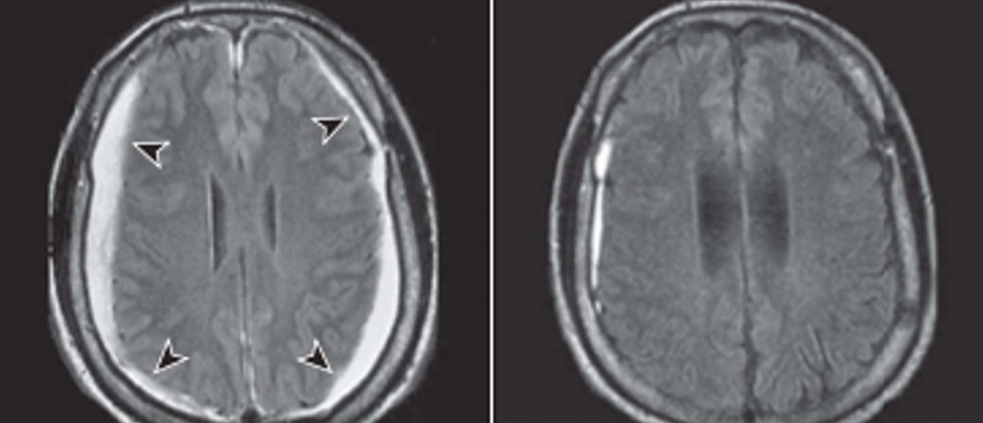 Spontaneous Intracranial Hypotension