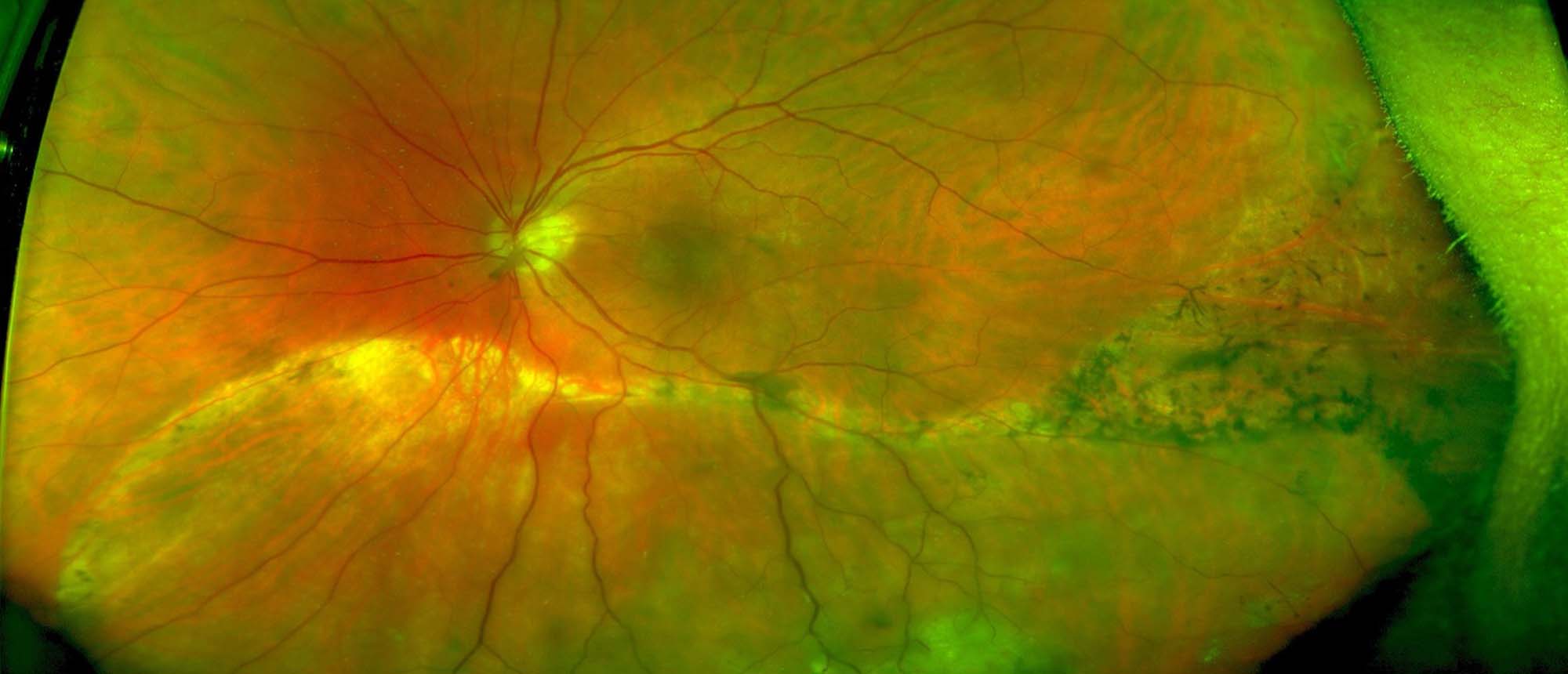 Pseudoangiomatous Retinal Gliosis (PARG)