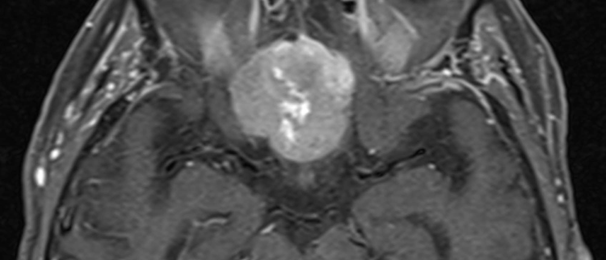 Radiation Optic Neuropathy