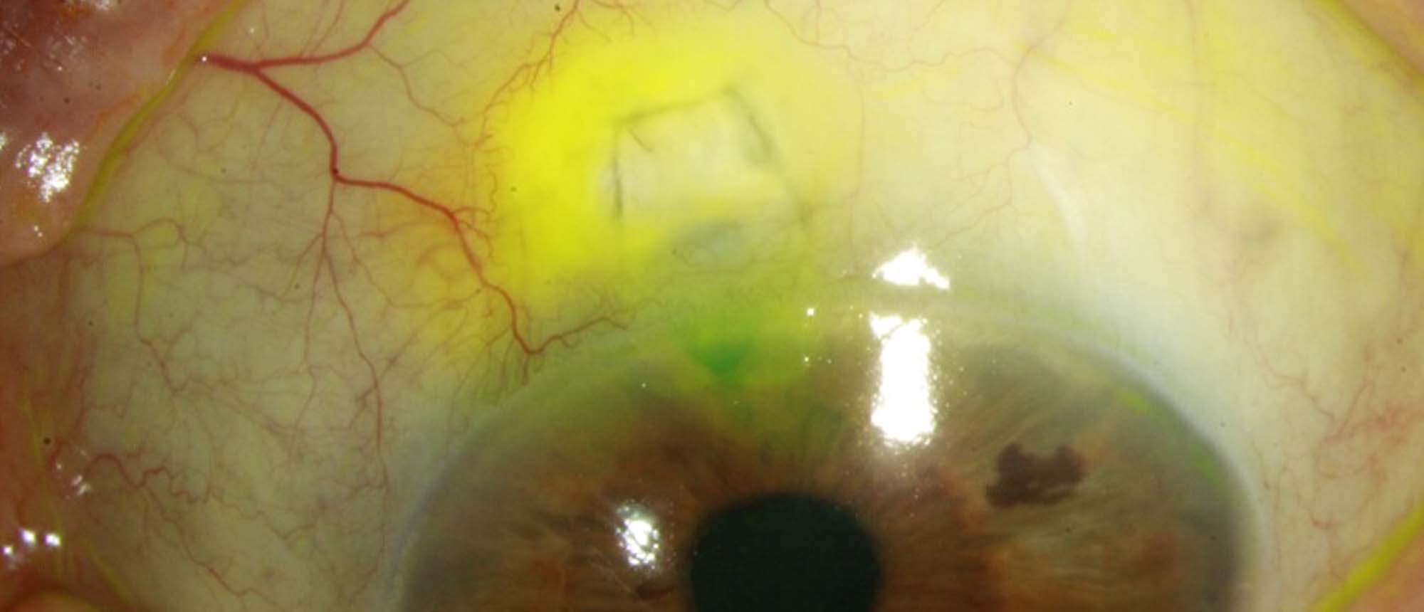 Hypotony Due to Cyclodialysis Clef