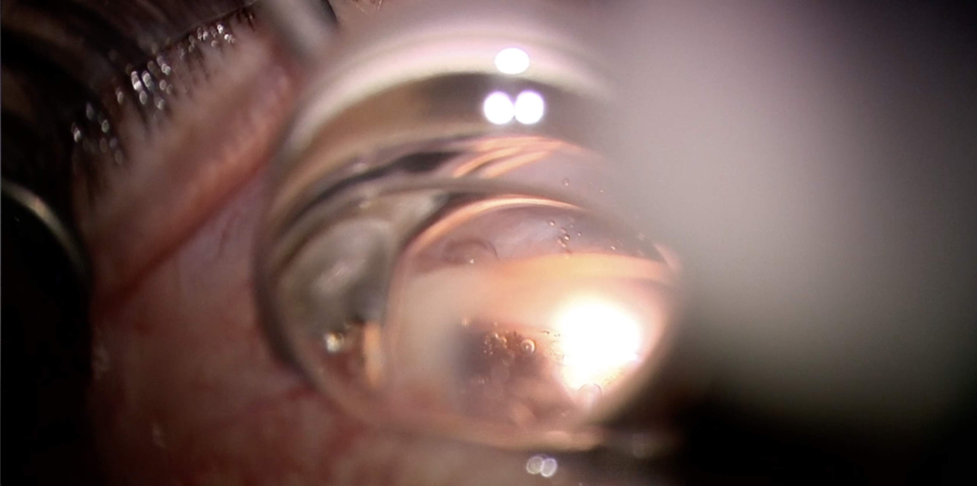 Endolaser Cyclodialysis Cleft Repair