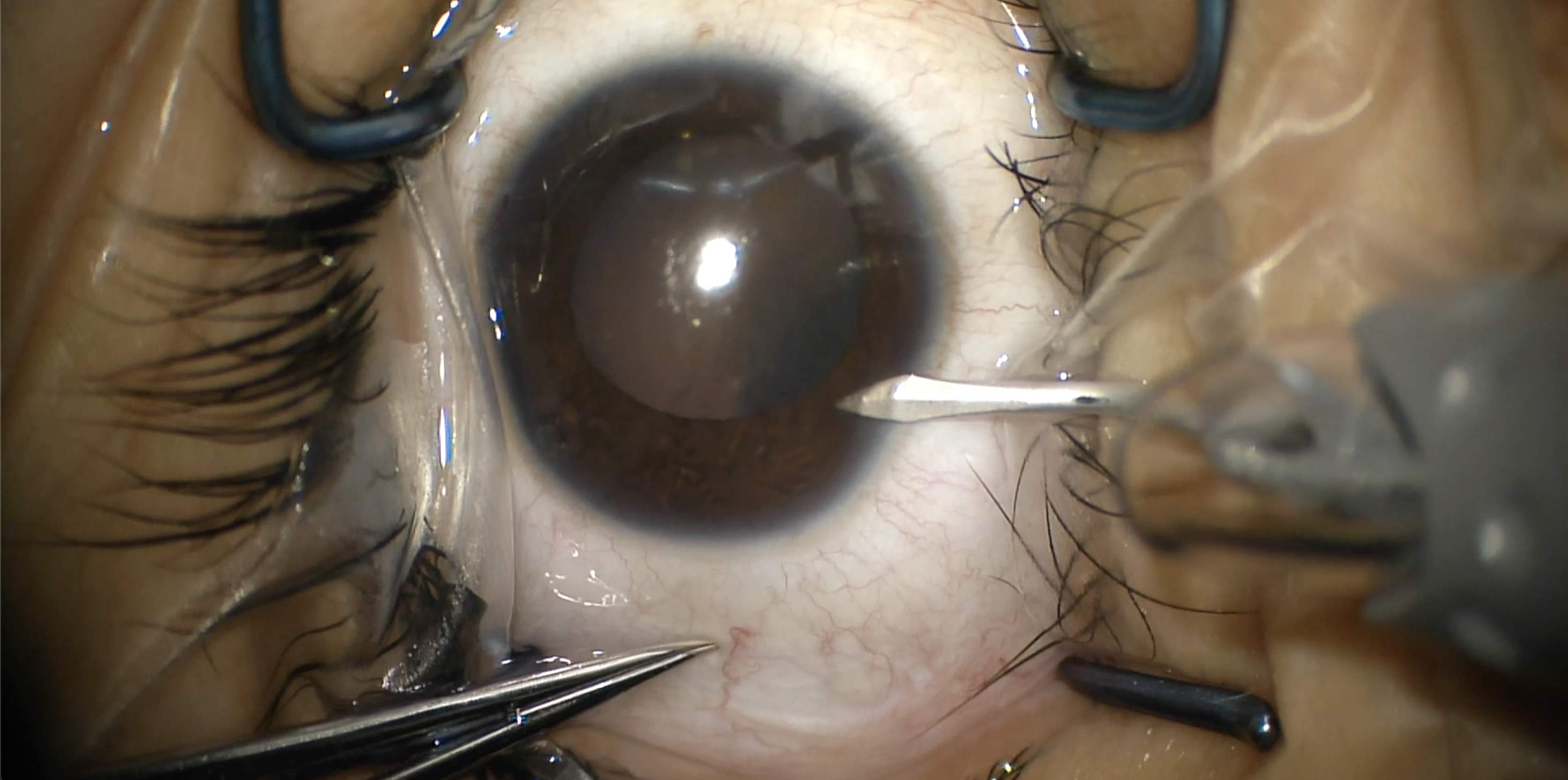 Implantable Collamer Lens