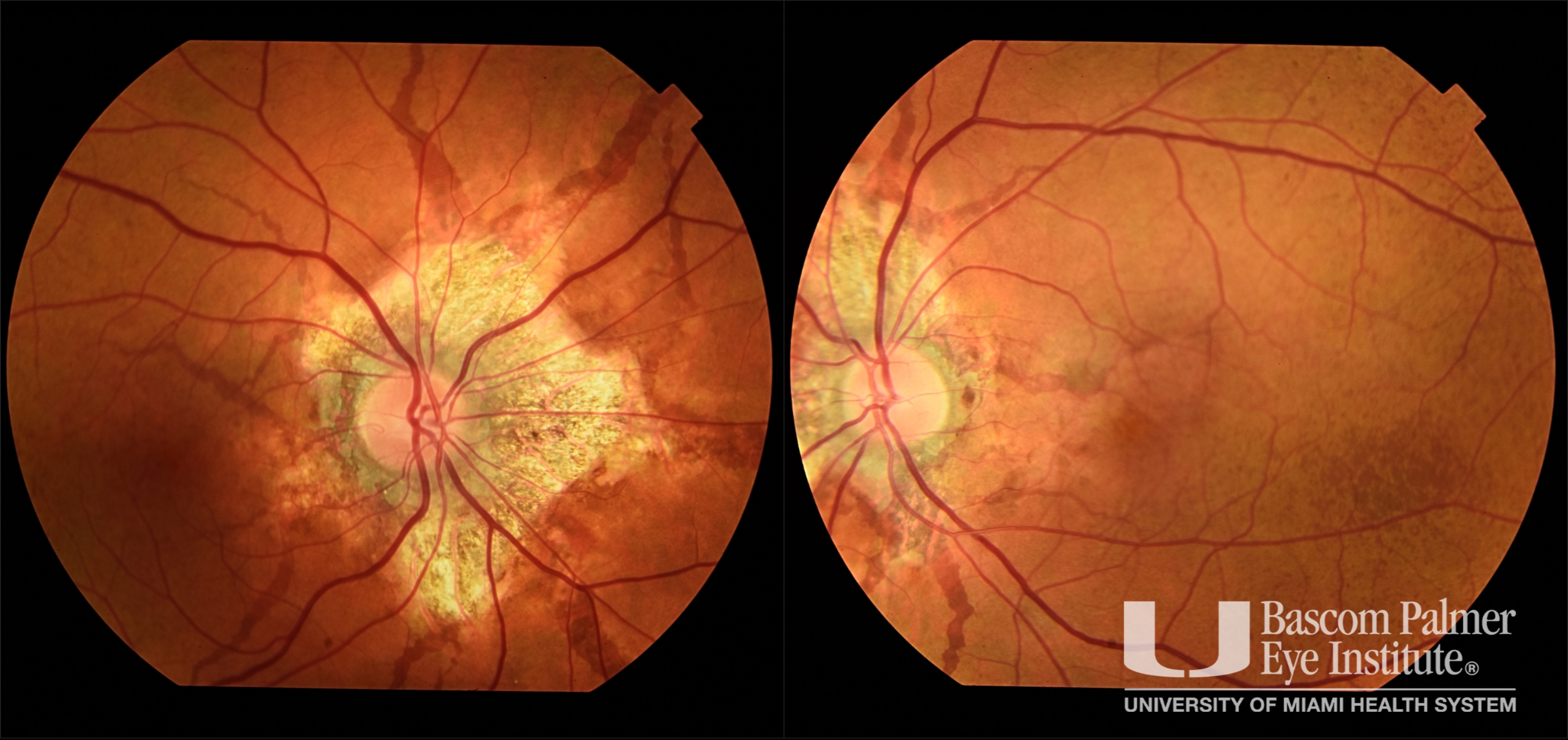 Pseudoxanthoma Elasticum