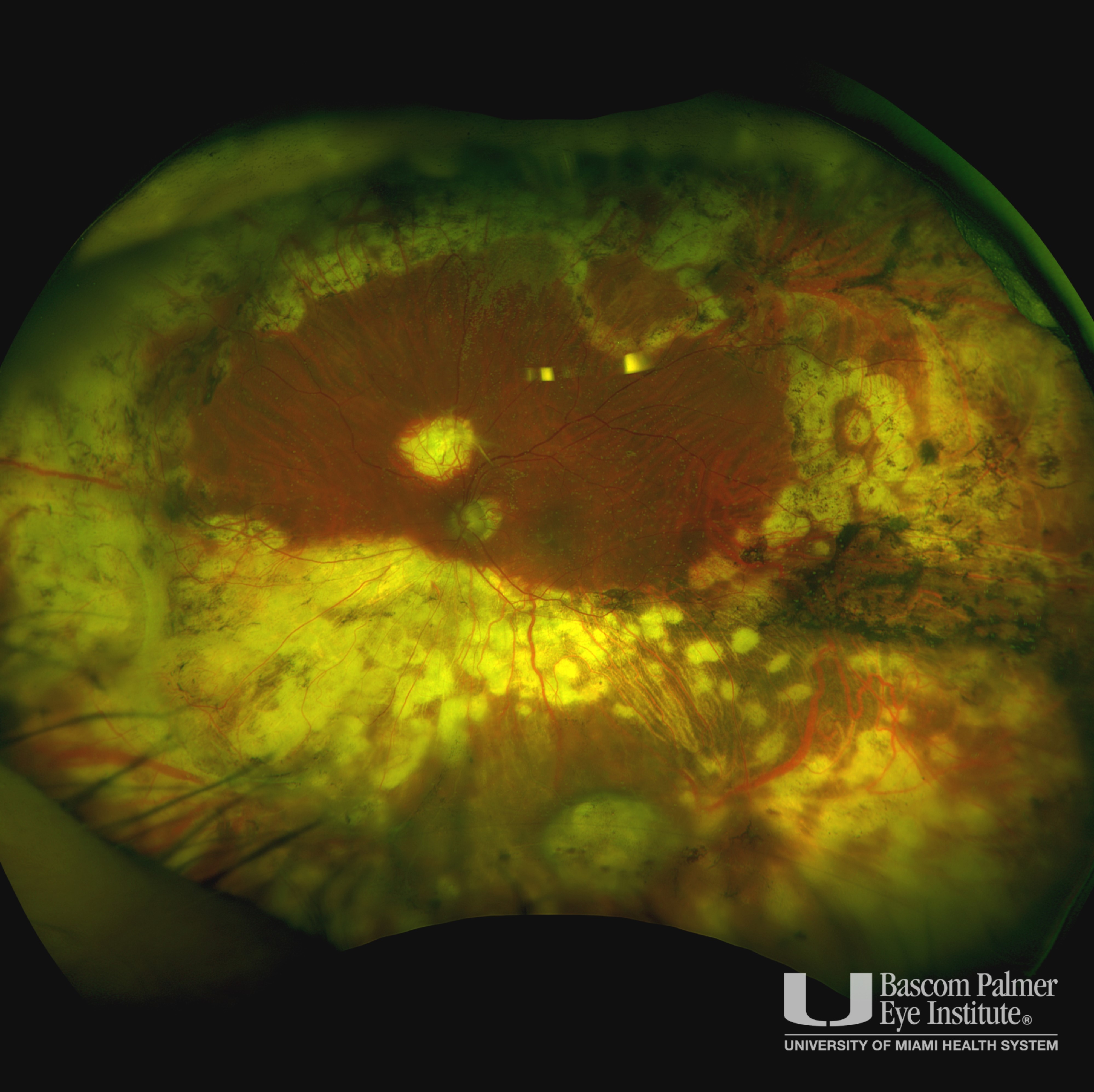 Fundus photography of patient treated with Iodine plaque, PPV and endolaser due to Pseudoangiomatous retinal glisois