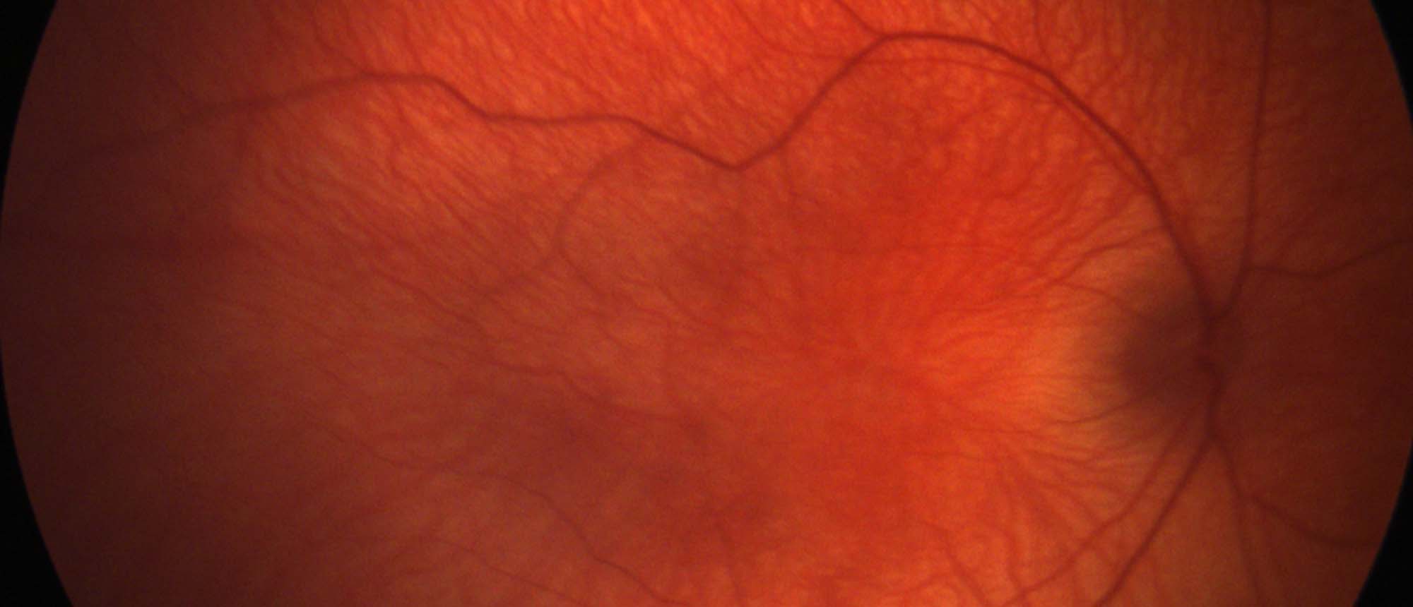 Hermansky-Pudlak Syndrome